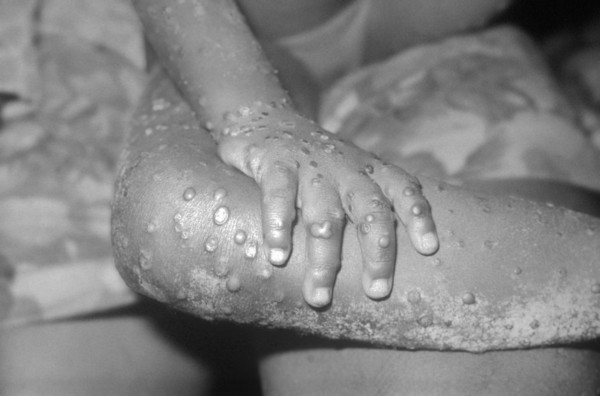Monkeypox-600x396